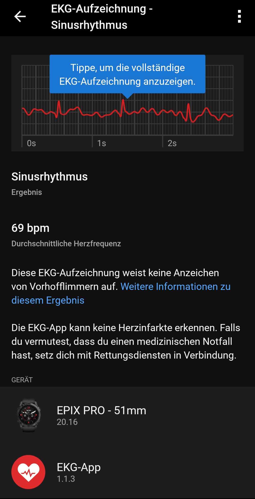 svg+xml,%3Csvg%20xmlns= Garmin EKG-Aufzeichnung